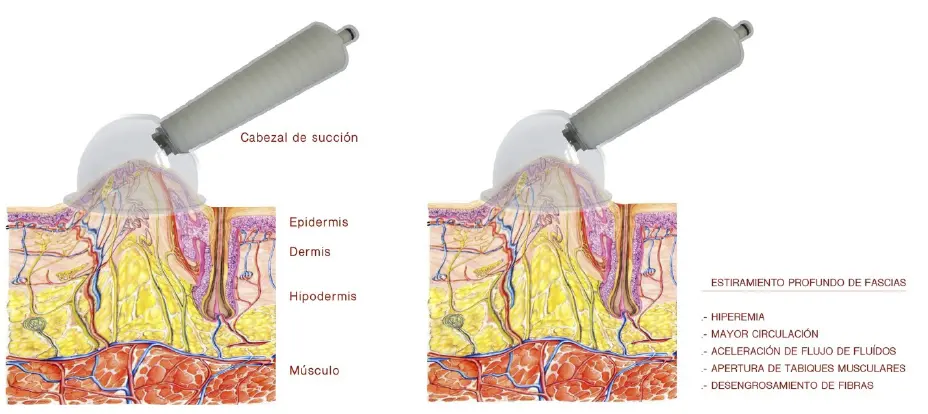 Esquema del cabezal de succión de THERAVAC y su acción sobre epidermis, dermis, hipodermis y músculo